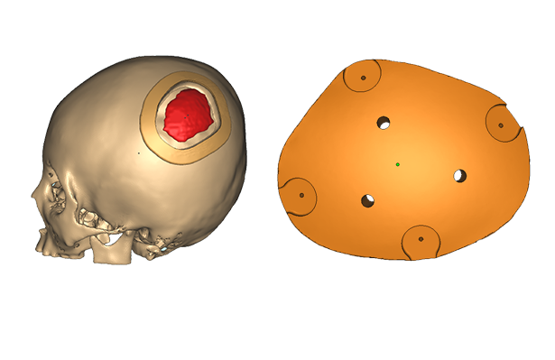 從顱骨、胸肋骨到胡桃夾綜合征，借助3D打印技術(shù)已完成上百例PEEK植入手術(shù)